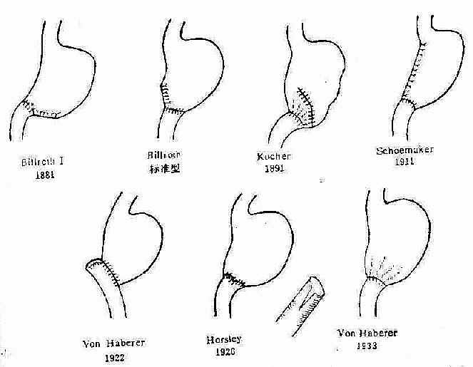 Billroth I ʽθ���г��������ı�Ǩ