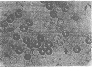 G6PDȱ��֢Ů���Ӻ��ӵ�����ѪƬʾǶ����