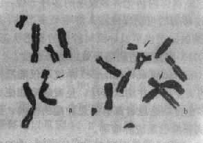 FanconiƶѪ���쳣Ⱦɫ��