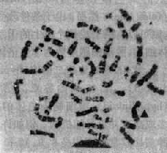 PhȾɫ��ʾ 9��22��λ��9q34;22q11��;��fi 22q-;��ʾ9+(�̾��ṩ)